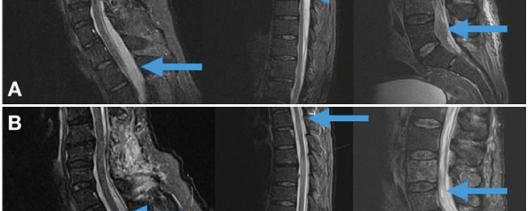 Cervical Thoracic Lumbosacral MRI